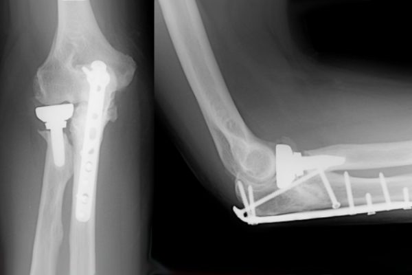 Elbow Surgery