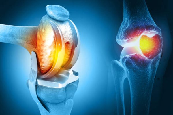 Human knee replacement surgery. Knee joint treatment. Knee injury. 3d illustration